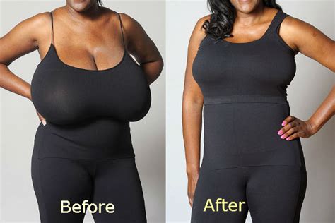 breast reduction before and after ddd