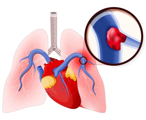 Consecuencias de solfa syllable trombosis pulmonar. Embolia pulmonar: sintomas, causas, risco de morte e ...