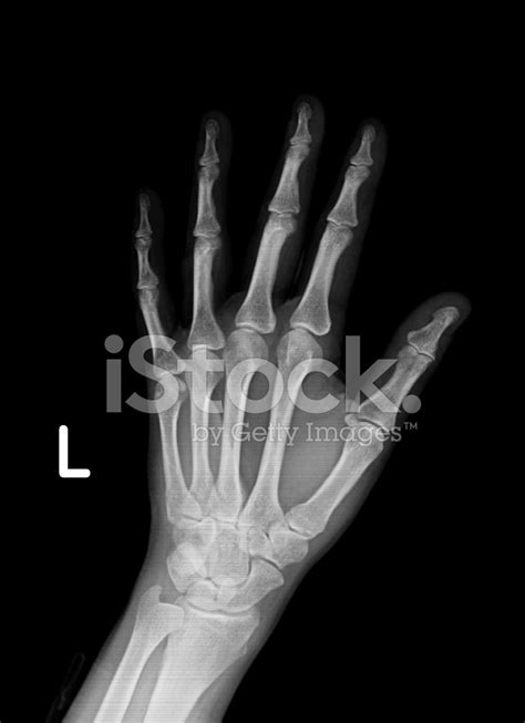 Xray Image Of Left Hand And Wrist Stock Photos