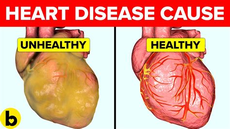 What Causes Heart Disease And How Can You Prevent It Youtube