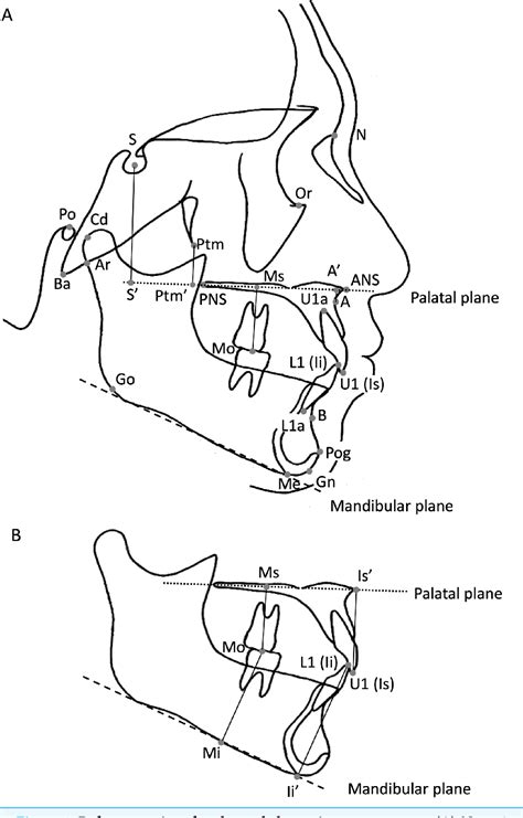 Figure 1 From Characteristics Of Craniofacial Morphology And Factors