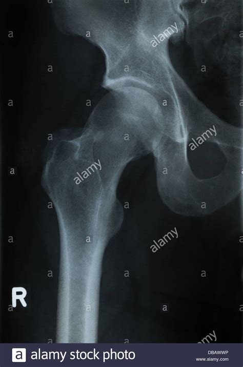 Human Hip Bones High Resolution Stock Photography And Images Alamy