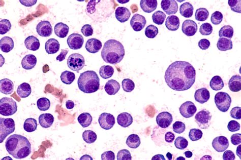 Monoclonal Gammopathy of Undetermined Significance (MGUS)