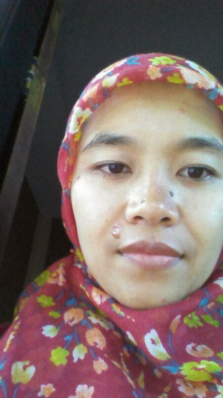 Join facebook to connect with tahi hidung masin and others you may know. My little note: operasi tahi lalat / electrocutter