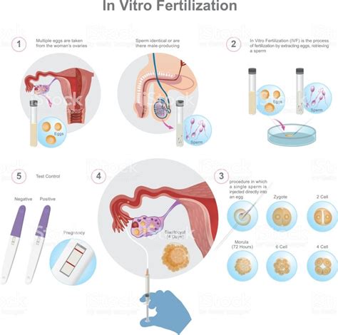 In Vitro Fertilization Is A Process Of Fertilisation Where An Egg Is