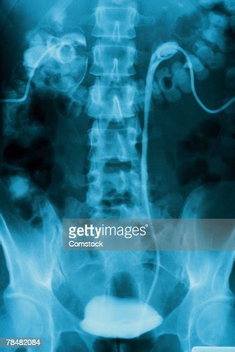 Xray Of Pelvis And Spine High Res Stock Photo Getty Images