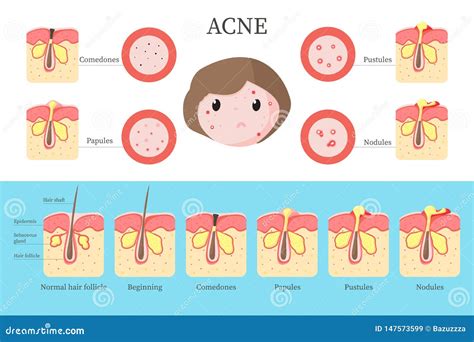 Acne Types And Formation Infographics Vector Flat Illustration Stock