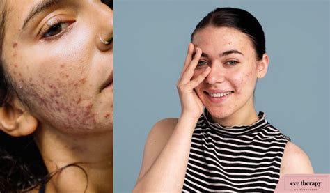 Severe Acne How To Manage And What To Avoid Eve Therapy