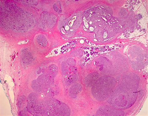Pathology Outlines Epithelial Myoepithelial Carcinoma