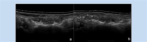 The inguinal ligament and scarpa's fascia from the abdomen. Panoramic ultrasound views of the lower abdomen before and ...