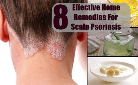8 Effective Home Remedies For Scalp Psoriasis Treatment And Cure For