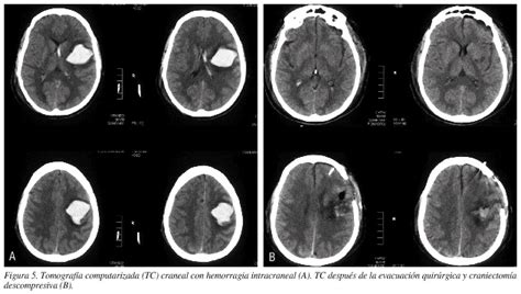 ¿es posible reanimar a alguien cuyo encéfalo ha dejado de funcionar? Actualización en hemorragia cerebral espontánea