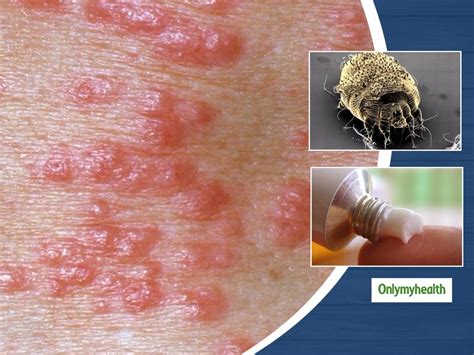 What Is Scabies Learn About Its Causes Symptoms And Treatment
