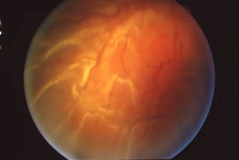 Retinal Detachment With Proliferative Vitreoretinopathy Retina Image Bank