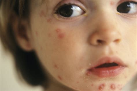 Infectious Illnesses In Children Nhsuk