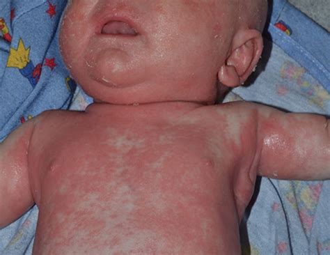 Neonate With Netherton Syndrome Note Skin Is Diffusely Erythematous