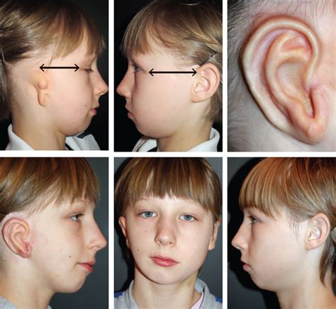 Chapter 5 Particular Cases Of Microtia Ento Key