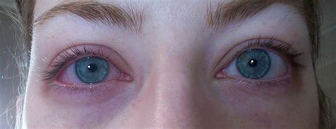 Transforming Hay Fever Eyes Amy Antoinette