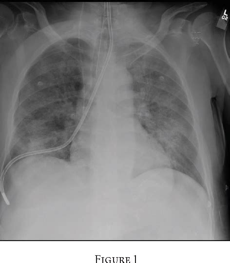 Figure 1 From Tension Pneumothorax And Subcutaneous Emphysema