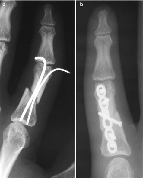 Malunionnonunion Of The Digits Musculoskeletal Key