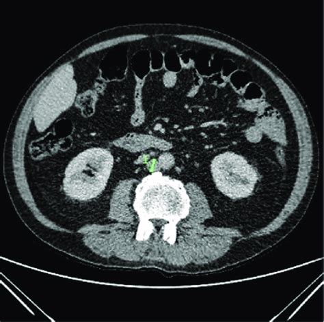 June 2018 Ct Chest Showing Solitary Borderline Enlarged Lymph Node
