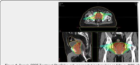 Sbrt Prostate Cancer All About Radiation