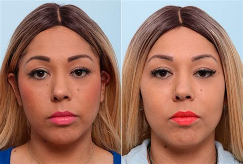 Buccal Fat Pad Removal Photos Houston Tx Patient 27775