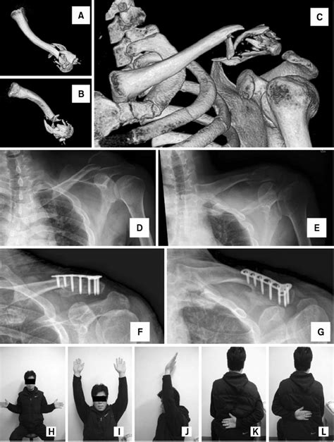 A 39 Year Old Man Sustained A Clavicle Lateral End Fracture By A