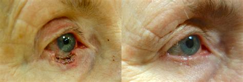 Eyelid Skin Cancer Mohs Reconstruction Before And After Photos