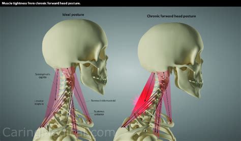 Forward Head Posture Symptoms And Complications Caring Medical Florida