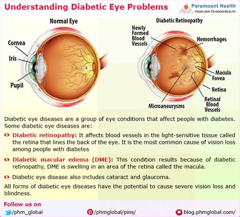 Paramountedaily Understanding Diabetic Eye Problems Tinyurl
