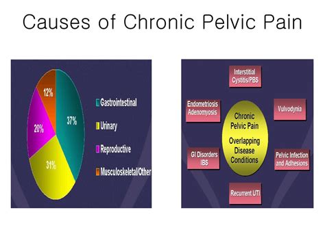 Ppt Chronic Pelvic Pain Pelvic Congestion Syndrome Powerpoint