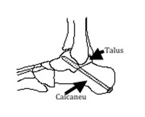 Subtalar Arthrodesis Surgery | Foot Surgeon Minneapolis MN