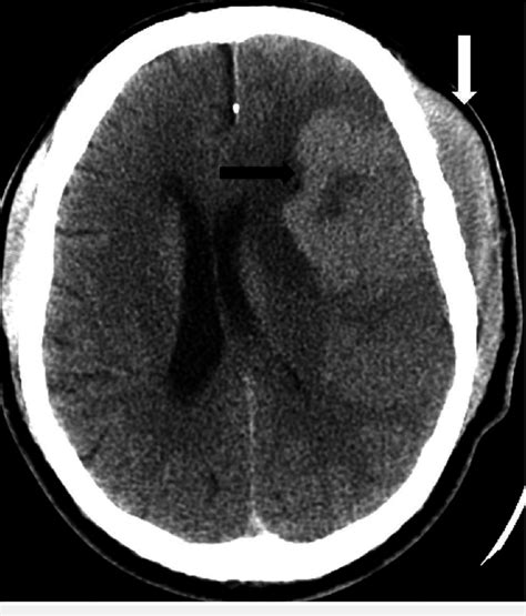 Noncontrast Head Computed Tomography Ct Demonstrates A Transcalvarial