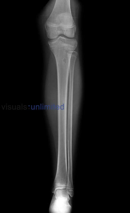 Normal Leg X Ray Of A 13 Year Old Girl Visuals Unlimited