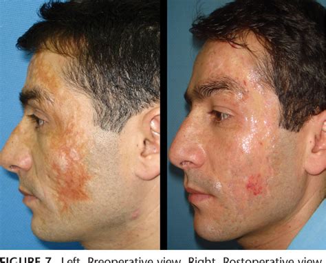 Treatment Of Facial Burn Scars With CO Laser Resurfacing And Thin Skin Grafting Semantic Scholar