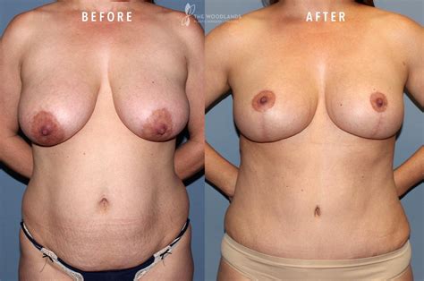 Mommy Makeover Before After Gallery The Woodlands Plastic Surgery