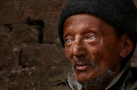 Since being founded in 1924 they have helped to diagnose, treat and rehabilitate people affected by leprosy. ¿Lepra curativa? - National Geographic en Español