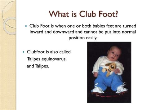 Children do better if you develop a fixed routine for the bracewear. PPT - Club Foot PowerPoint Presentation - ID:2103716