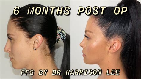 6 Month Post Op Facial Feminisation Surgery Dr Harrison Lee Haydie