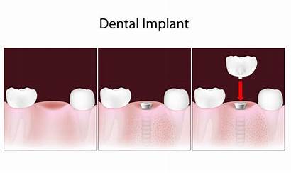 Dental Implants Types Benefits Procedures Problems Possible