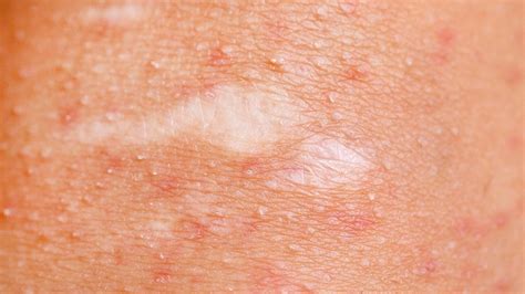 How To Prevent And Treat 8 Common Skin Conditions
