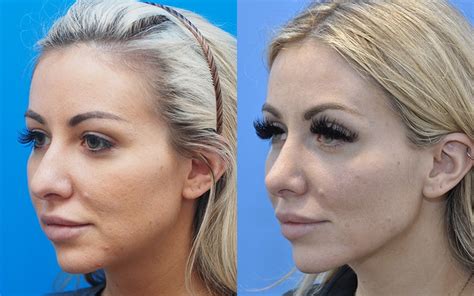 Rhinoplasty Nose Surgery Case 4512 Beaty Facial Plastic Surgery