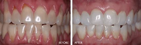 Flap Surgery Or Gum Surgery Aruma Dental