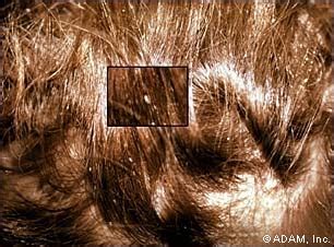 Head Lice - Symptoms, Diagnosis, Treatment of Head Lice ...