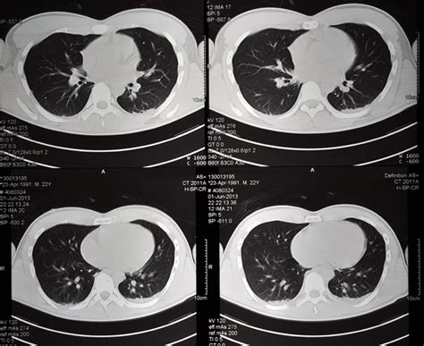What Is A Lung Ct Scan Two Views