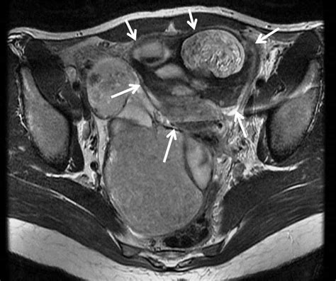 Cureus A Missed Diagnosis Of Ovarian Torsion In A Patient With
