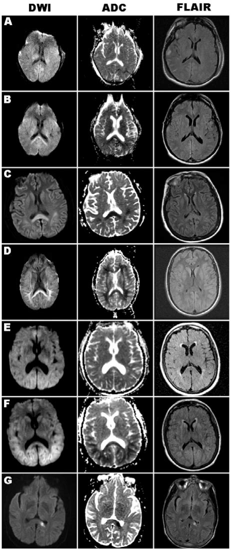 Axial Brain Mri Images Of Dwi Adc And Flair Sequences Obtained In