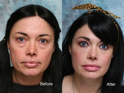 Lower Eyelid Surgery Recovery Time Lid Lift Beverly Hills