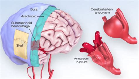 What You Should Know About Cerebral Aneurysms American Stroke Association